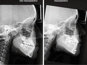 anomalia-dentofacial-clase-3.jpg